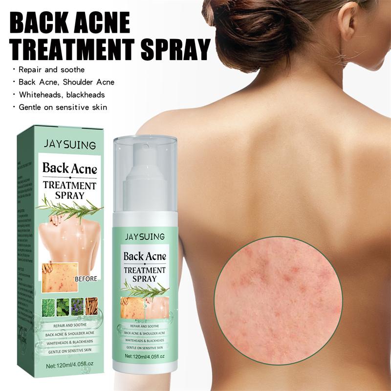 Back Acne Treatment Spray, Herbaluxy Back Acne spray, Anti Acne Marks Spot Removal Serum Moisturizing, Acne Treatment for Clear Back and Body Acne Moisture Skincare Gentle Sensitive Moisturizer Moisturize Hydrating Skin Repair acne treatment