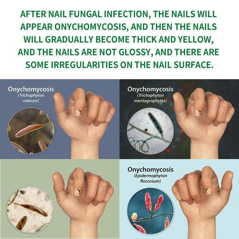 Ginger Nail Treatment for Dry and Brittle Nails - Antibacterial Daily Support