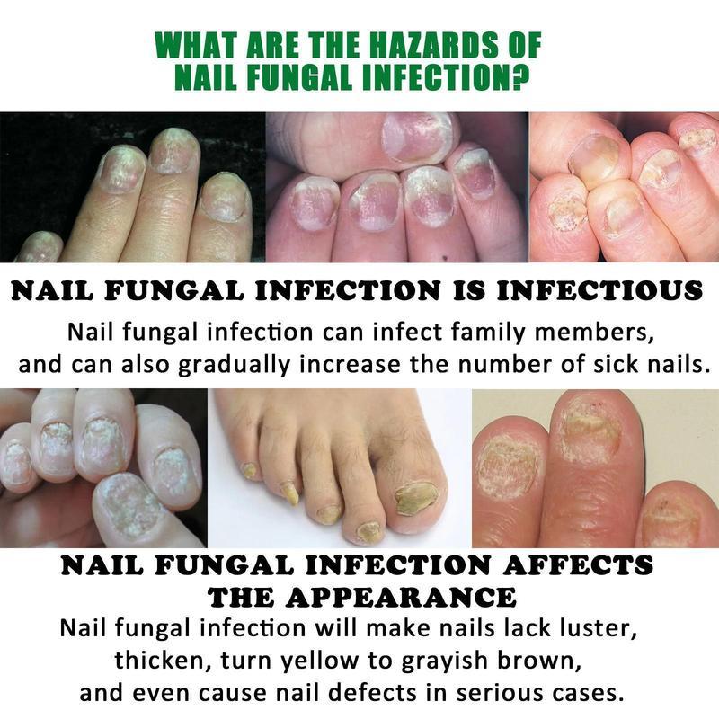 Ginger Nail Treatment for Dry and Brittle Nails - Antibacterial Daily Support