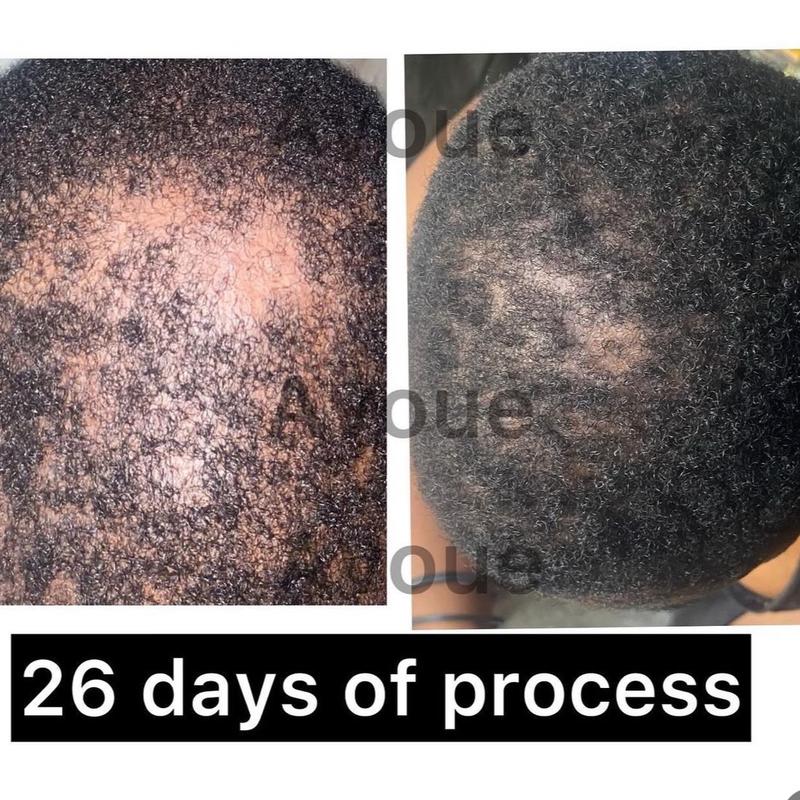 Hair Growth Avocado Butter and Oil Anti Alopecia Treatment for Hair Loss