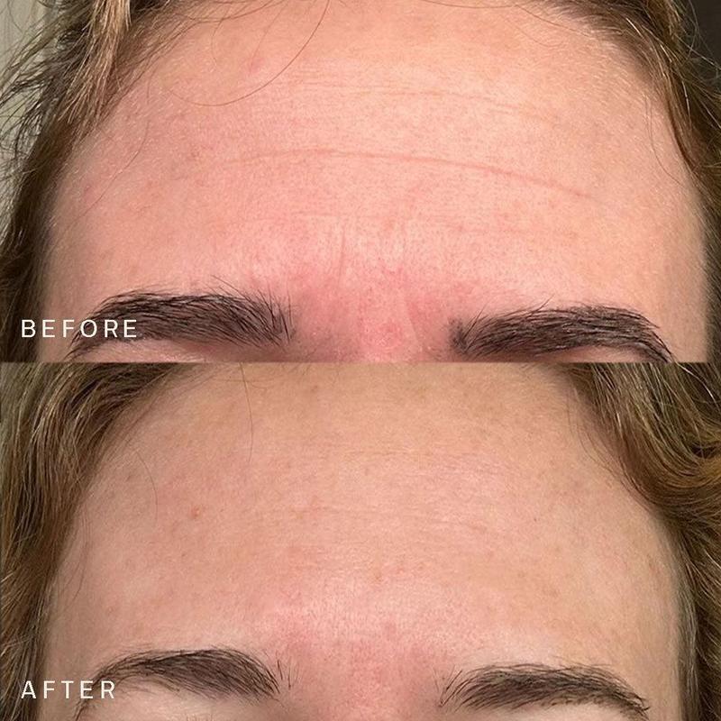 SILICONEFUSION™ Forehead Patches