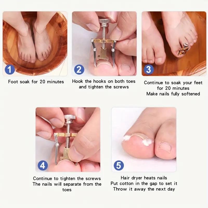 Ingrown Toenail Lifter, Ingrown Toenail Corrector, Softens and Trims Nails Easily, Pedicure Tool for Recovery, Christmas Gift